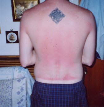 Mike's sunburned back